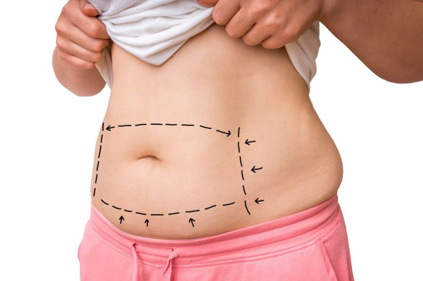 Diastasis Recti: What It Is and How to Treat It Without Surgery